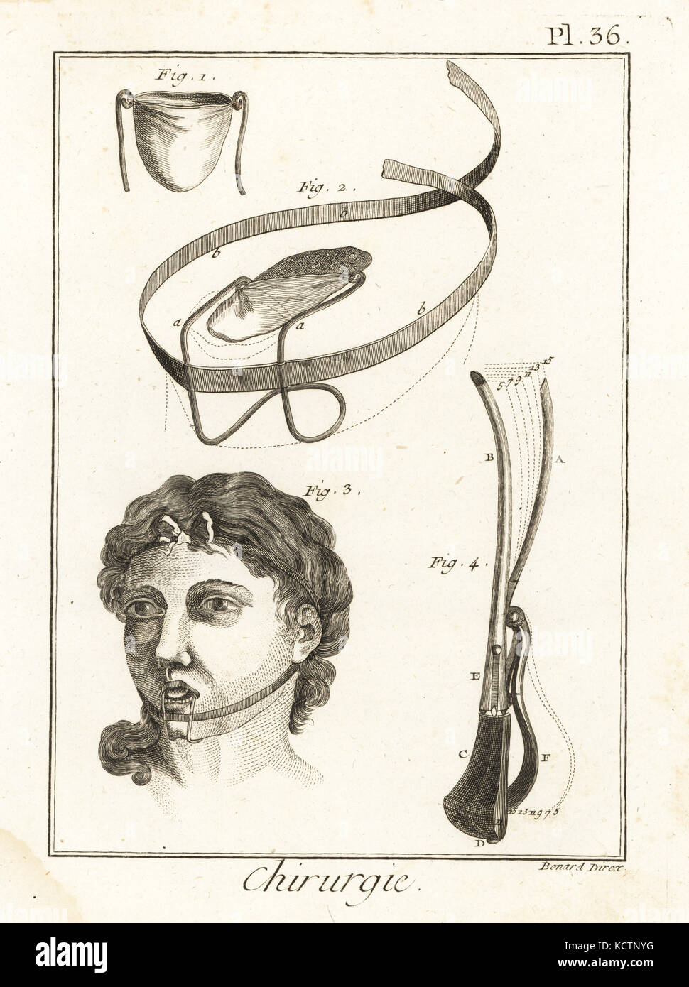 Doctor Pibrac's bandage for a tongue injury 1,2, the tongue bandage in place 3, and a lithotome, an instrument used to cut the bladder 4. Copperplate engraving by Robert Benard from Denis Diderot's Encyclopedia, Pellet, Geneva, 1779. Stock Photo