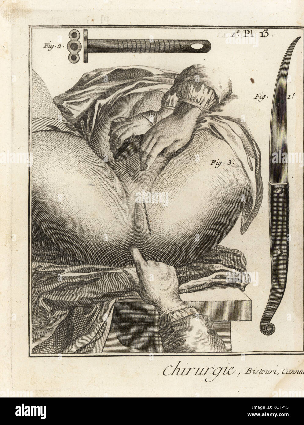 Foubert's surgical operation to remove a bladder stone: Mr Foubert's scalpel 1, flexible canula 2 and mark on the perineum for the external incision. Copperplate engraving by Robert Benard from Denis Diderot's Encyclopedia, Pellet, Geneva, 1779. Stock Photo