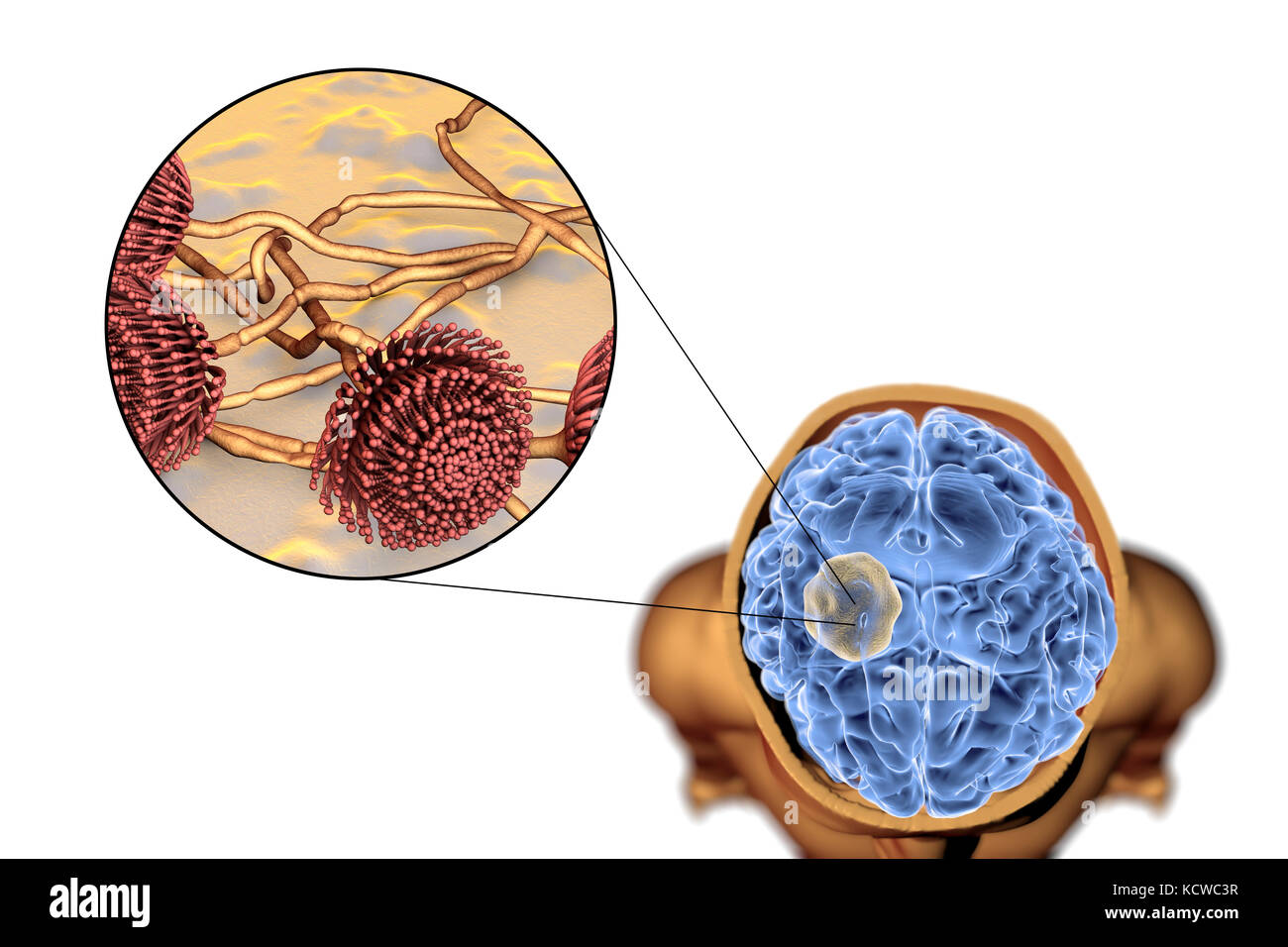 Aspergilloma of the brain and close-up view of Aspergillus fungi, computer illustration. Also known as mycetoma, or fungus ball, this is an intracranial lesion produced by Aspergillus fungi in immunocompromised patients. Stock Photo