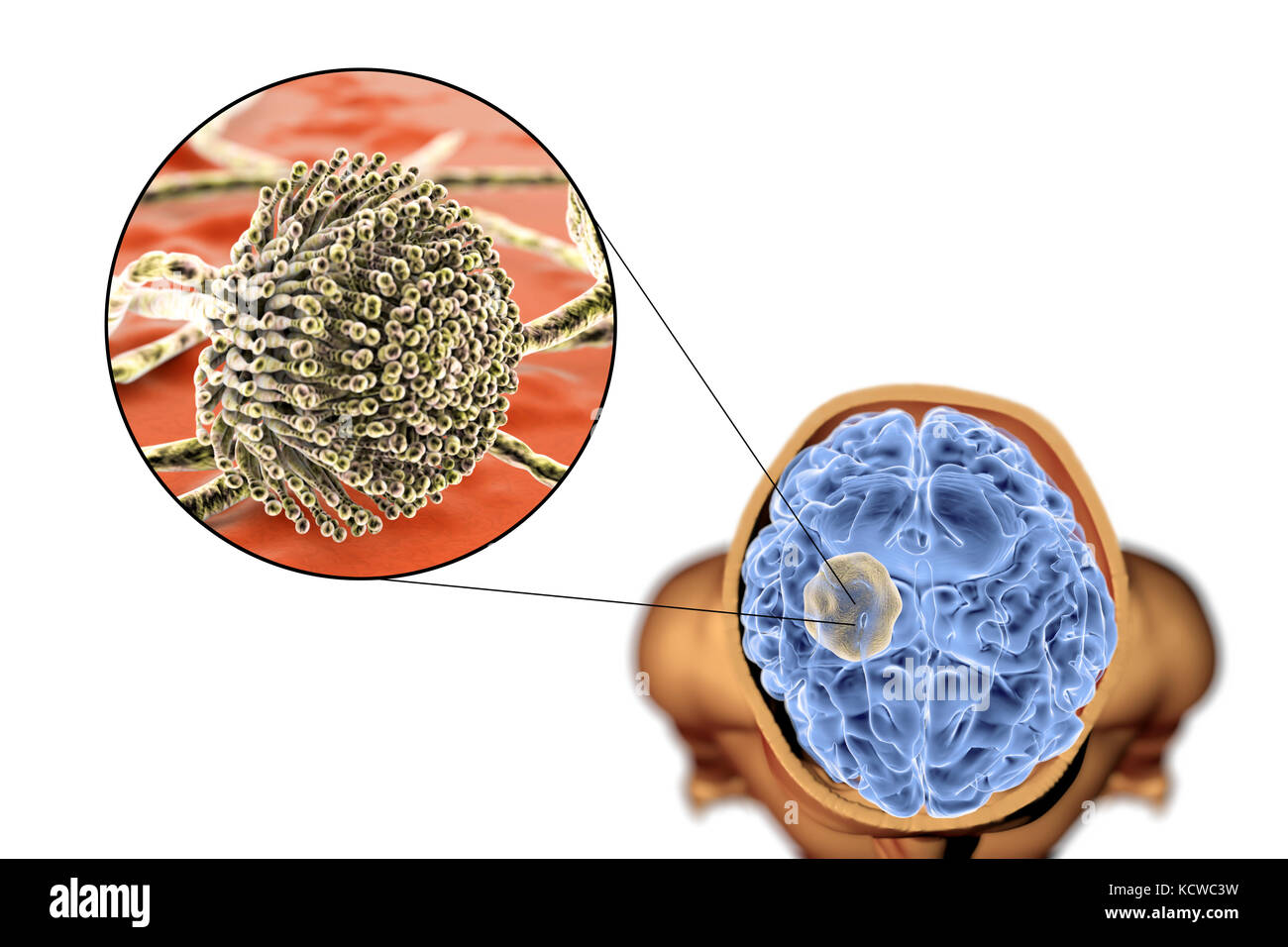 Aspergilloma of the brain and close-up view of Aspergillus fungi, computer illustration. Also known as mycetoma, or fungus ball, this is an intracranial lesion produced by Aspergillus fungi in immunocompromised patients. Stock Photo