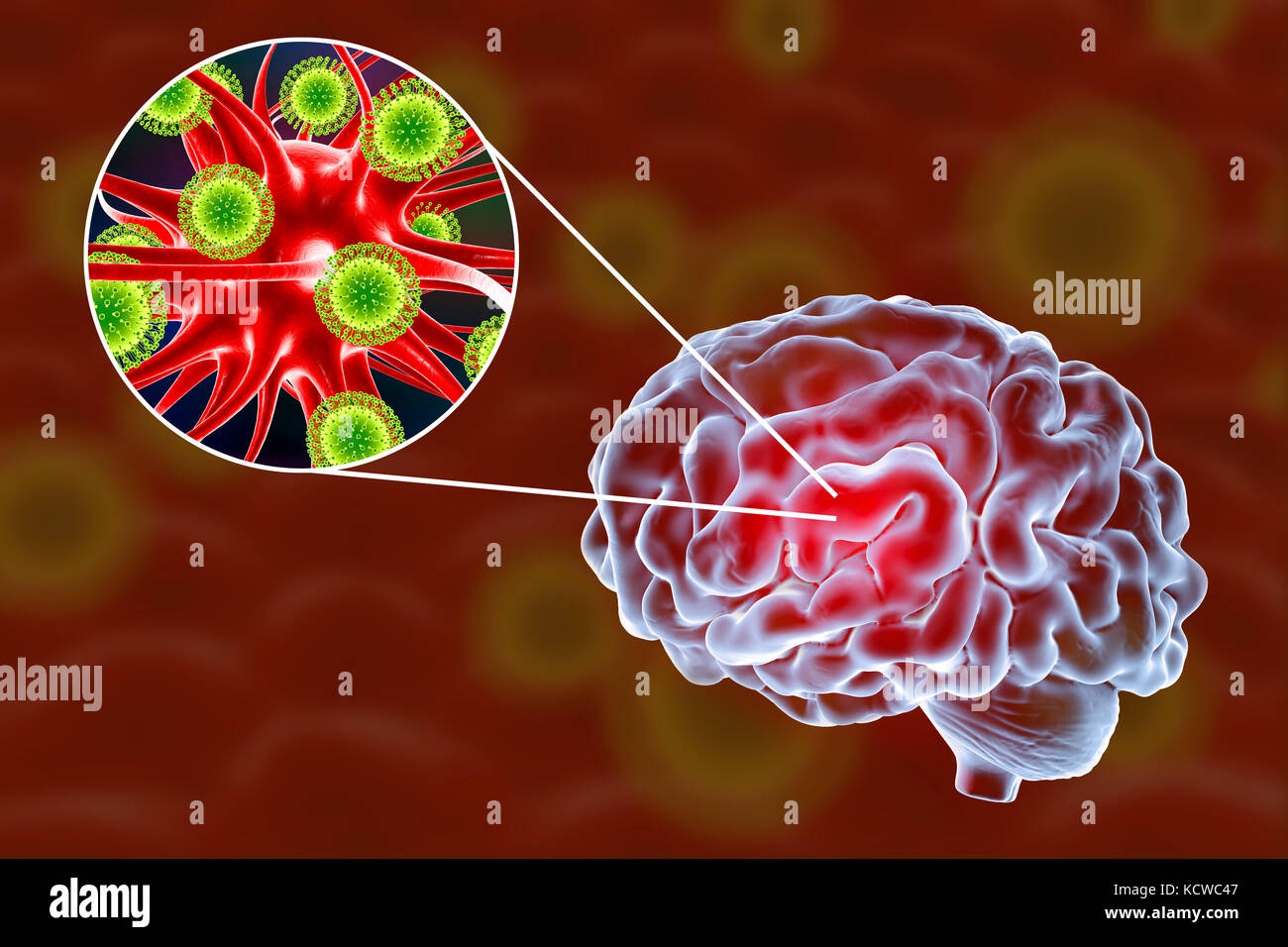 Viral encephalitis. Conceptual illustration showing brain and close-up ...