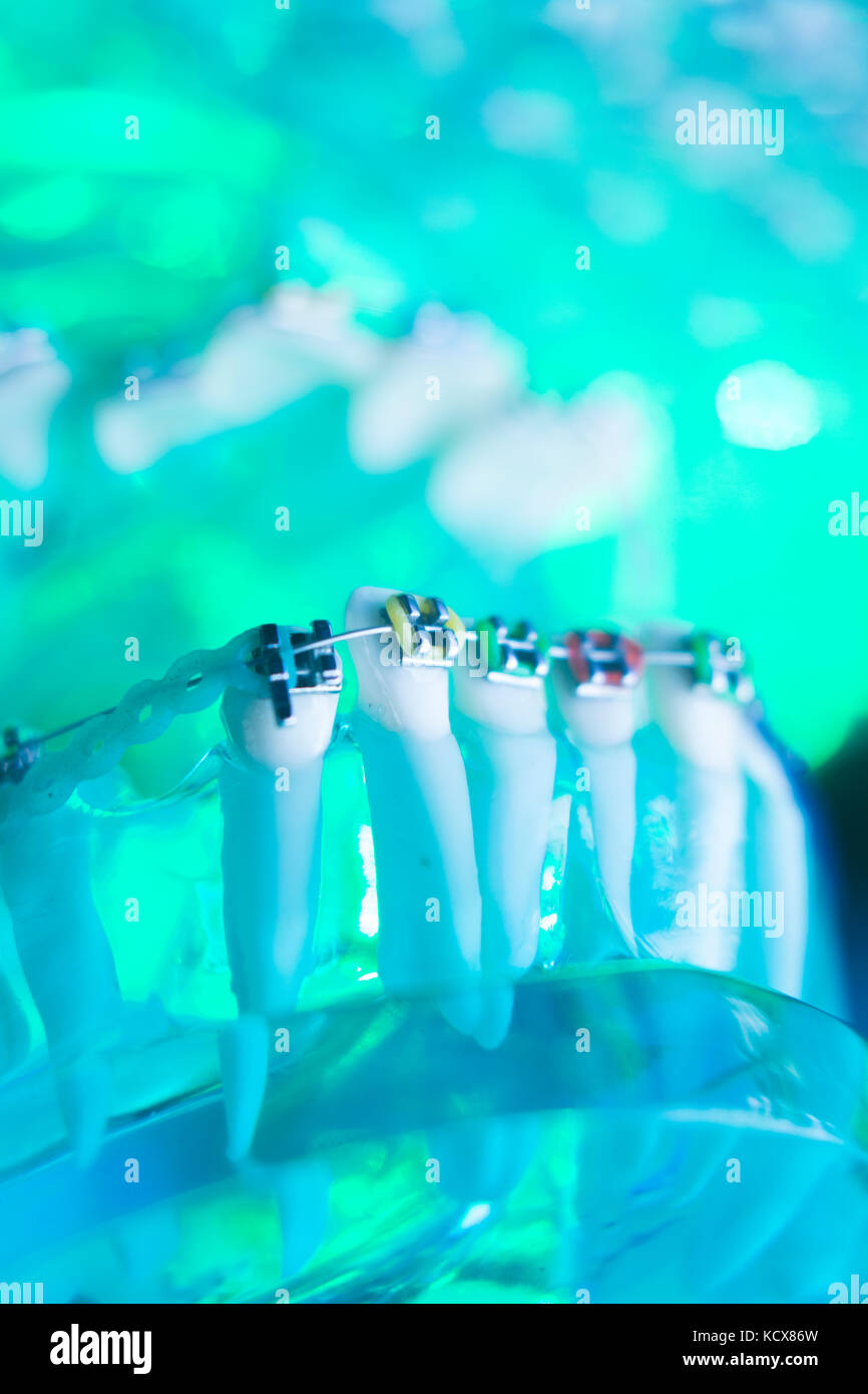 Dental teeth retainers metal aligners brackets to straighten teeth in