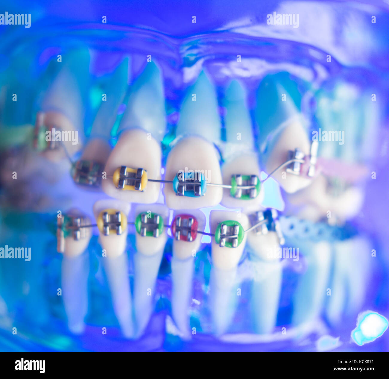 Dental teeth retainers metal aligners brackets to straighten teeth in orthodontic dentistry