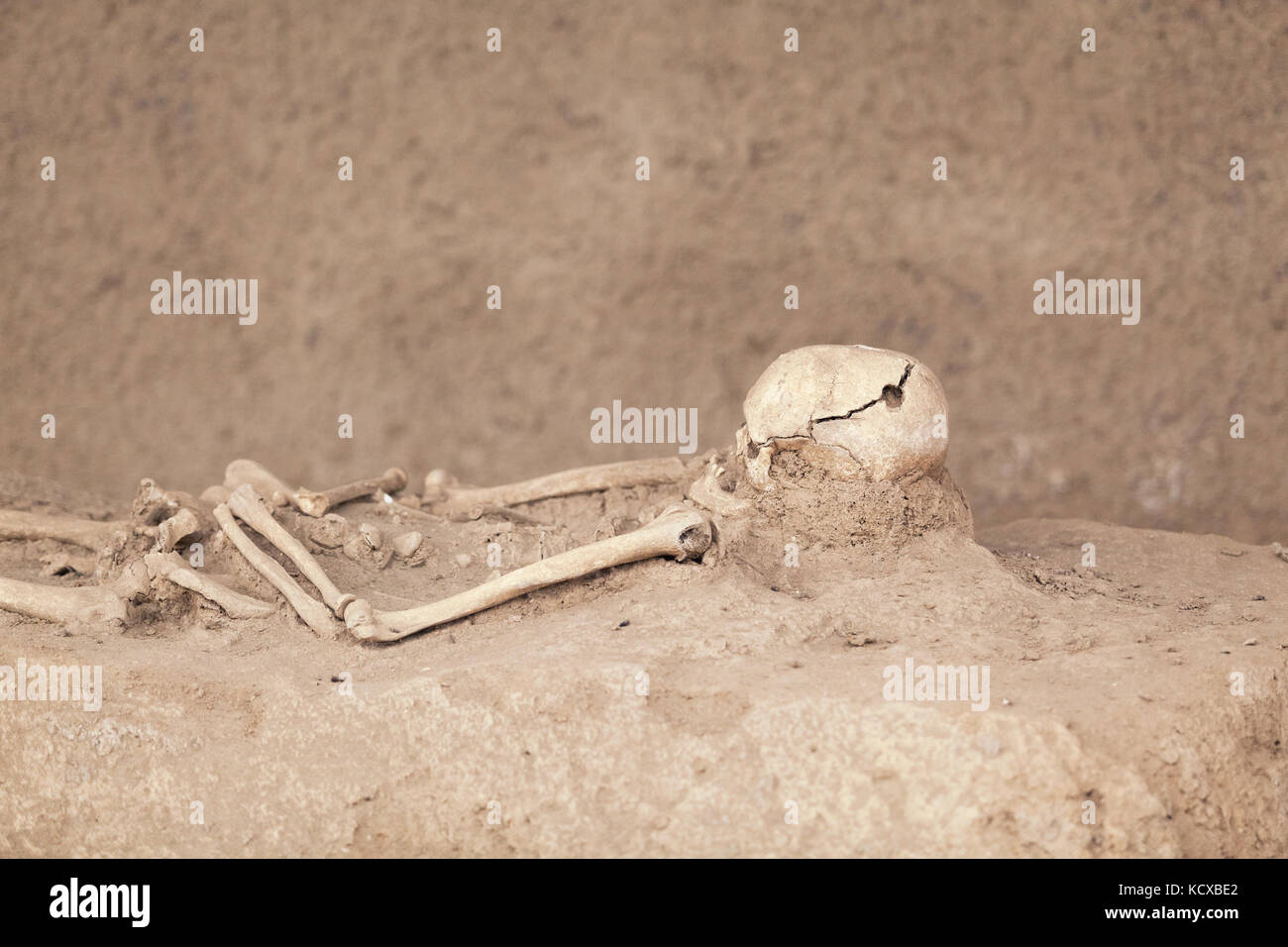 Trepanned skeleton Stock Photo