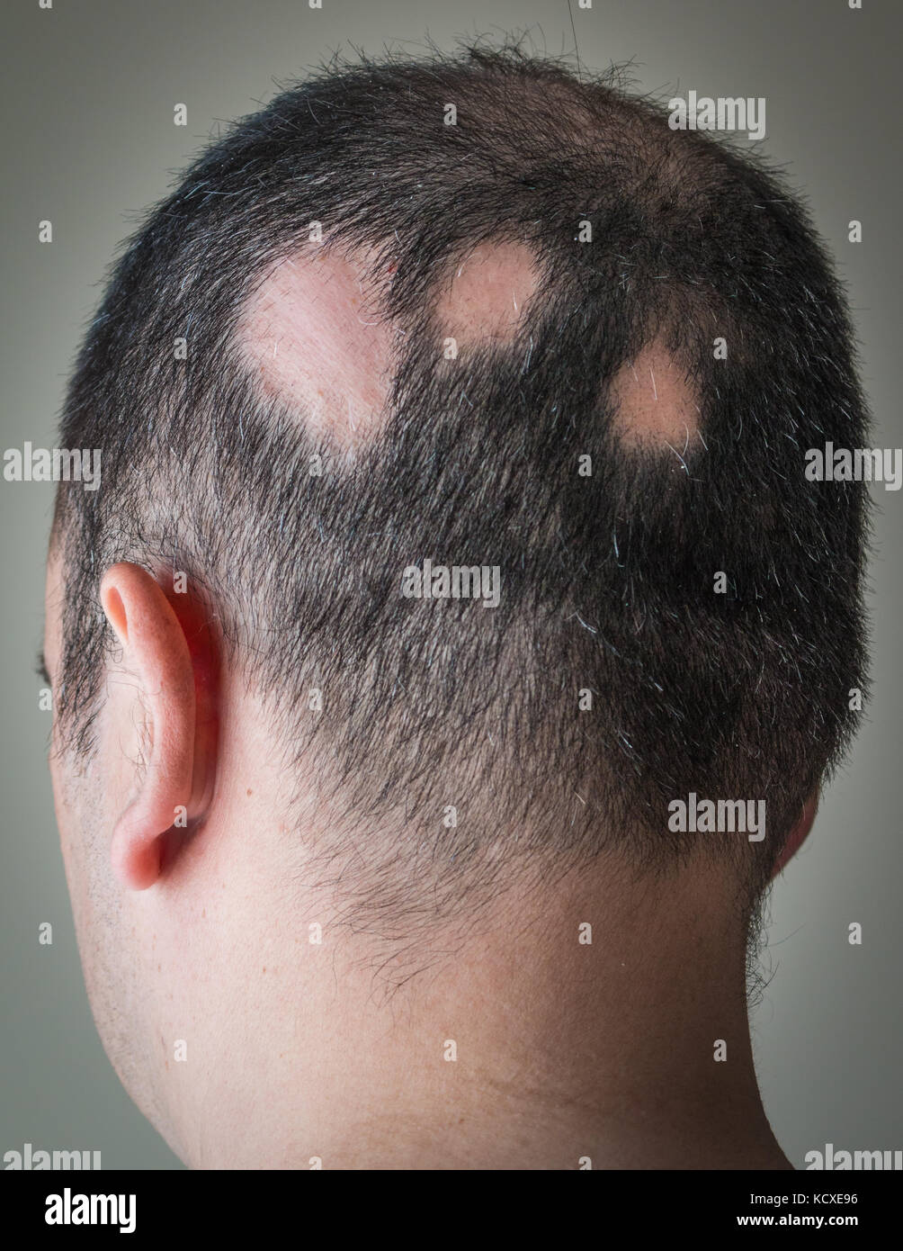 Alopecia Aerata - Spot Baldness Stock Photo