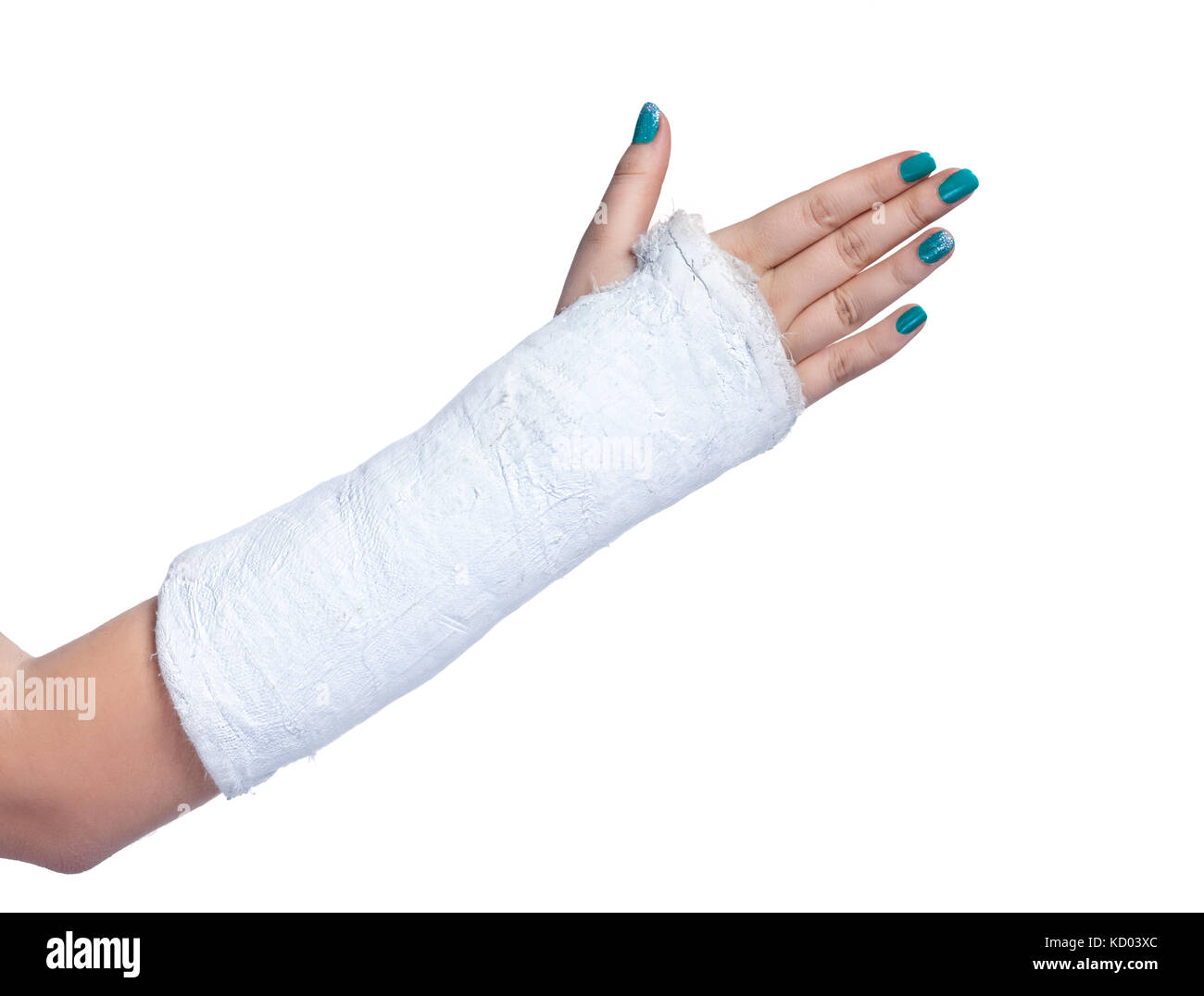 Hand in Cast on White Background Stock Photo - Image of closeup