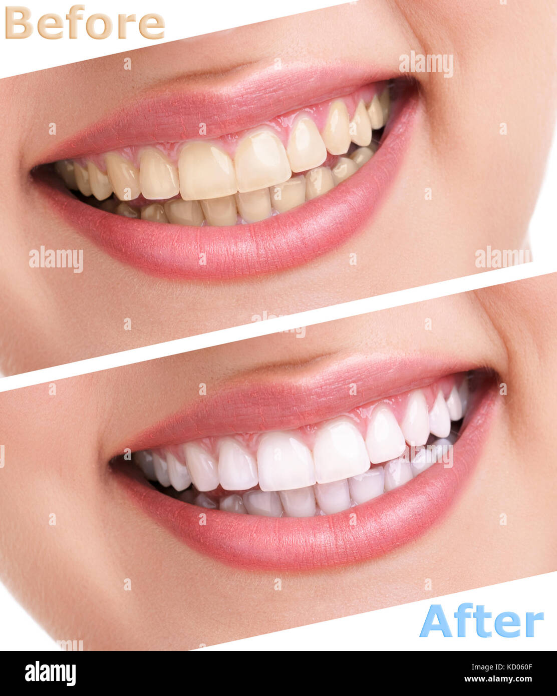 bleaching teeth treatment , close up, isolated on white, before and
