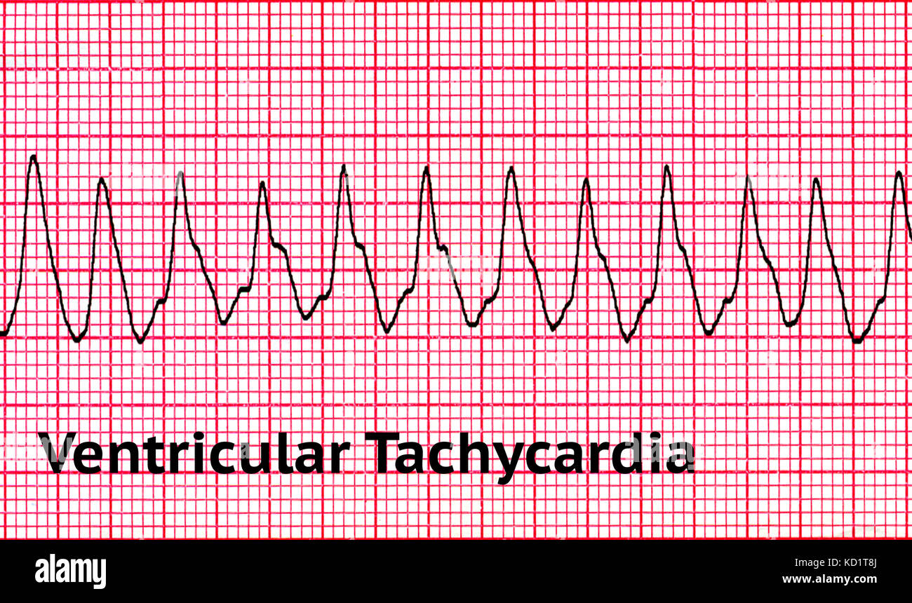 Ventricular tachycardia (VT) Stock Photo