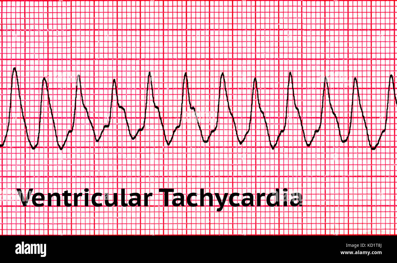 Ventricular Tachycardia VT Stock Photo Alamy Ventricular Tachycardia VT Stock Photo Alamy