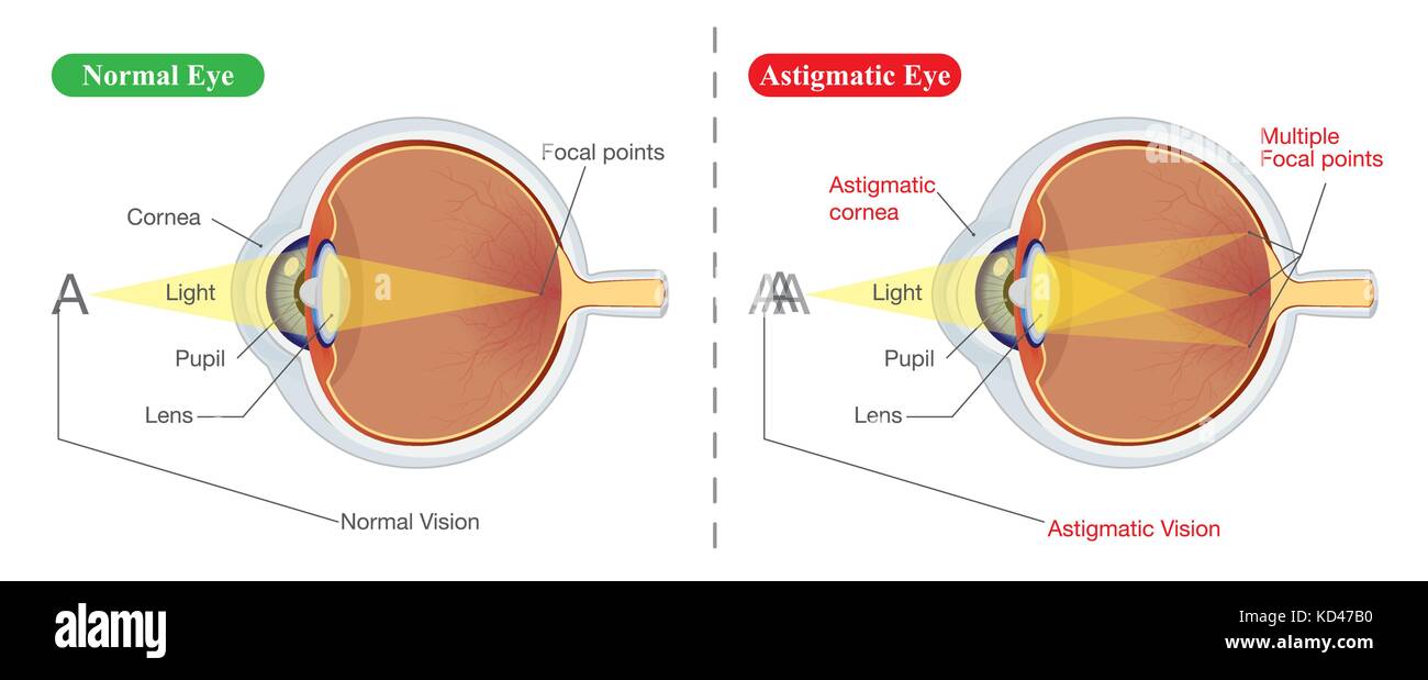 Vision of Normal eye and Astigmatic Stock Vector
