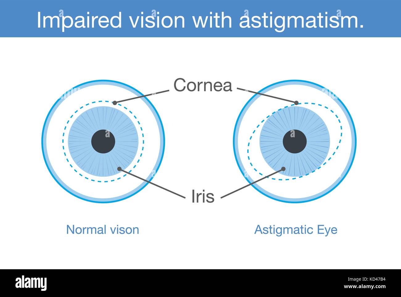 Normal vision and Impaired vision with astigmatism in front view Stock