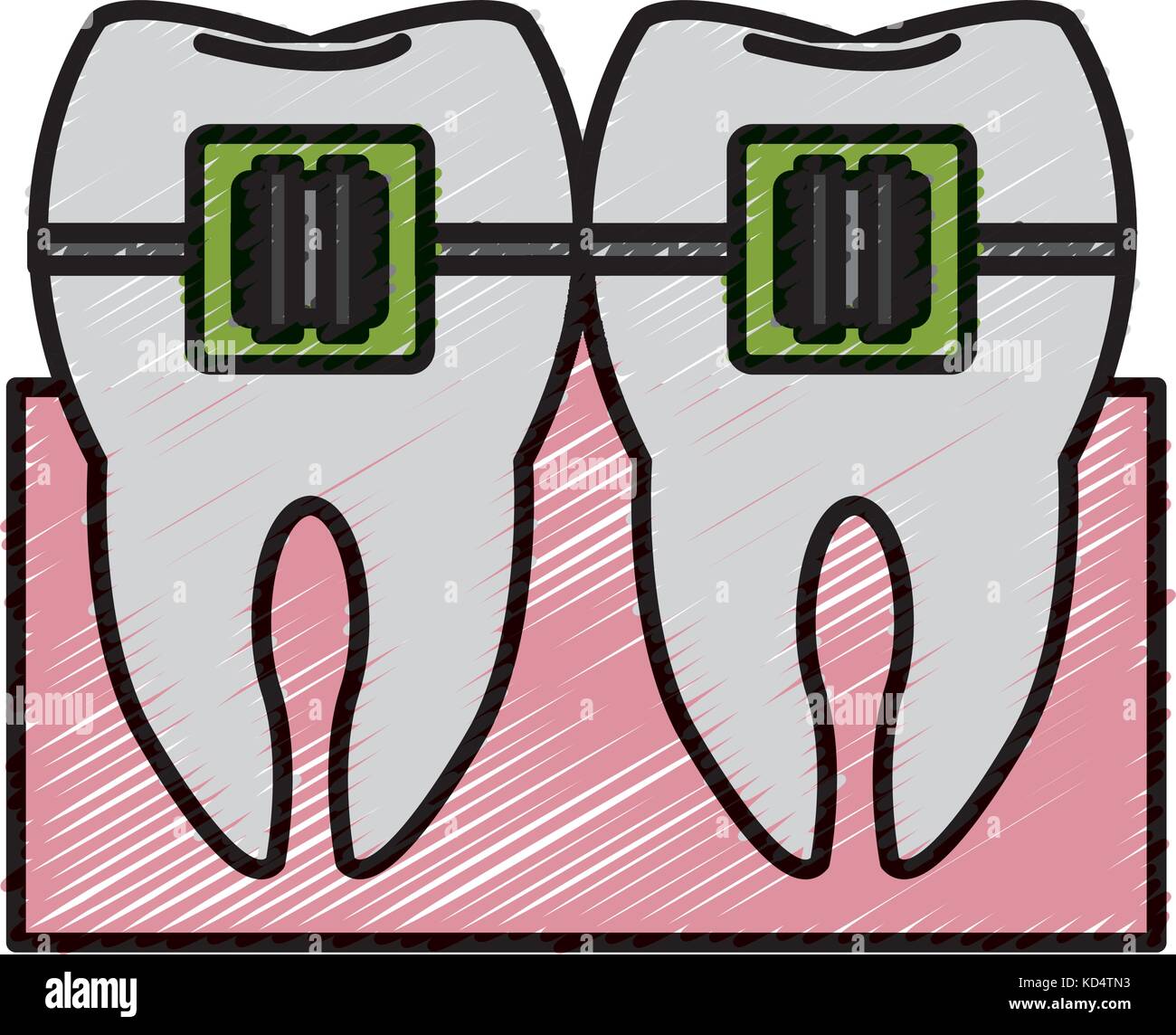 Tooth with bracket Stock Vector Image & Art - Alamy