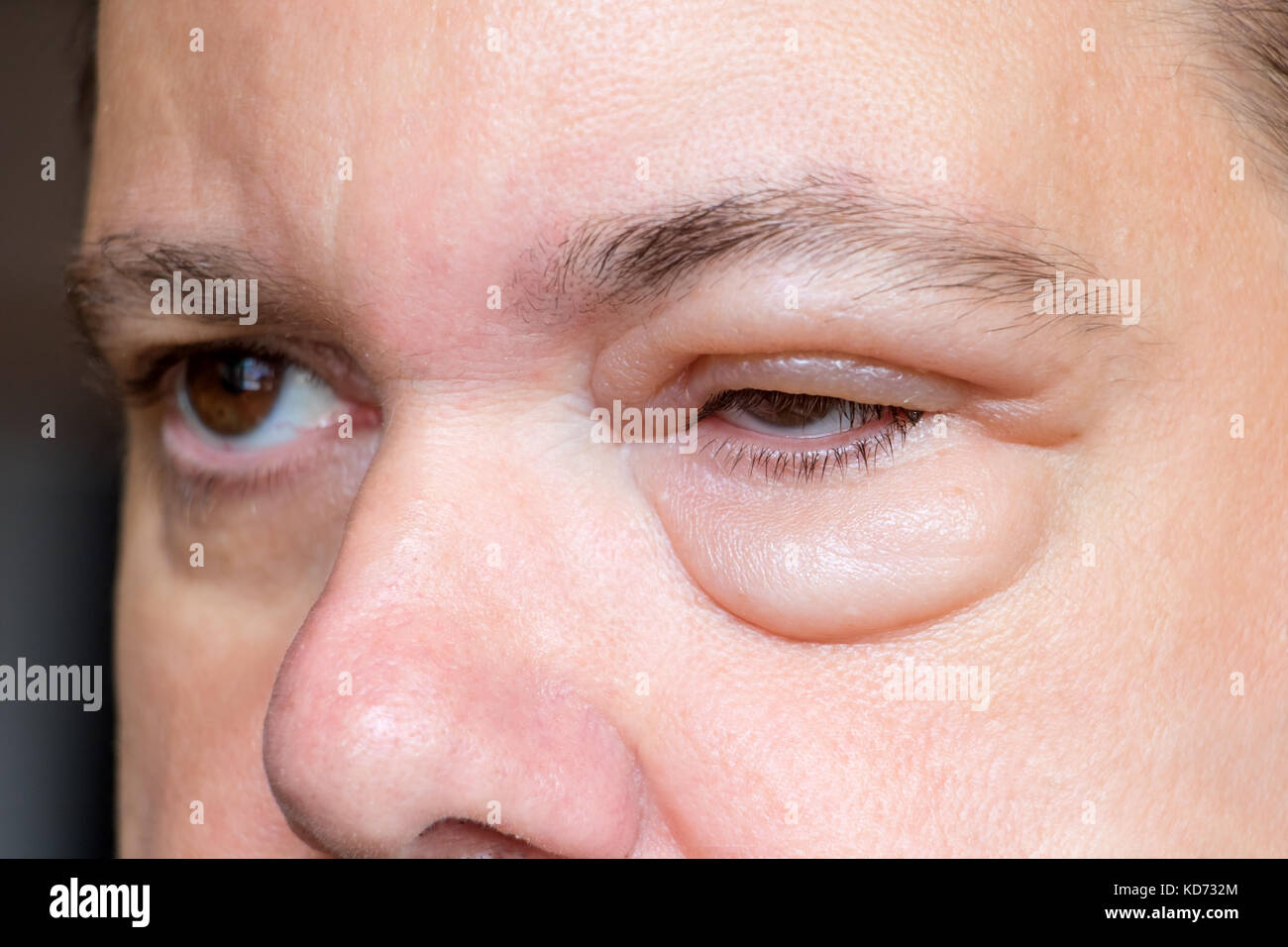Inflammation of the eyelid. Swelling of the eye after insect bite. A