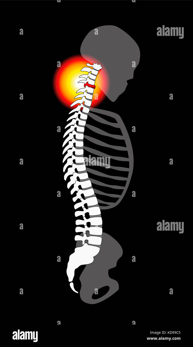 Spinal disc prolapse neck pain caused by cervical vertebrae profile view. Illustration on