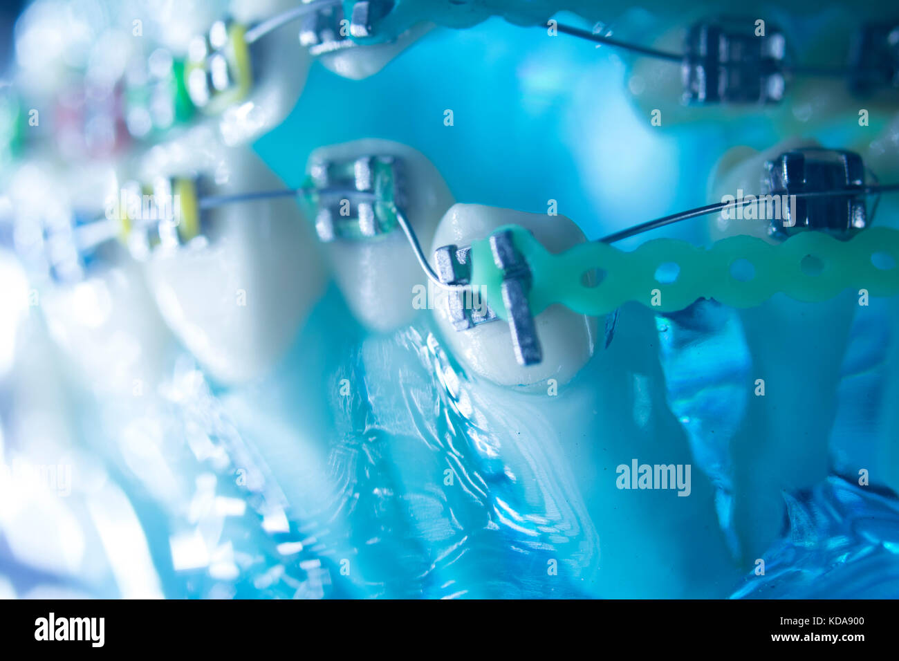 Dental teeth retainers metal aligners brackets to straighten teeth in