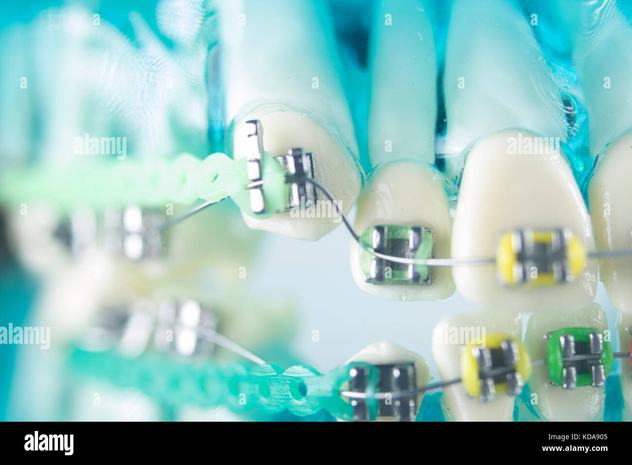 Dental teeth retainers metal aligners brackets to straighten teeth in orthodontic dentistry