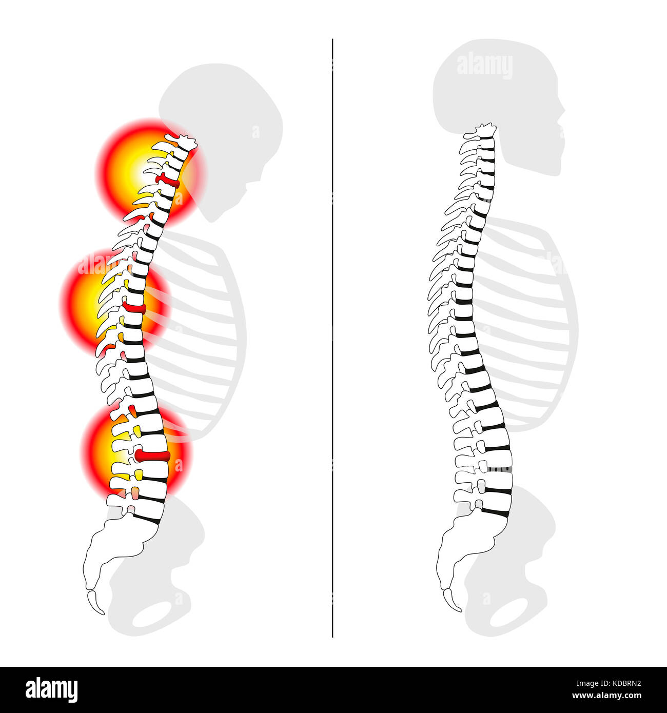 Slipped disc prolapses, curved back, severe back pain - profile views of spinal disc herniation versus upright healthy back. Stock Photo