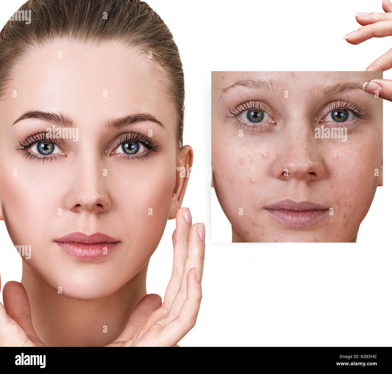 Woman shows photo with bad skin before treatment. Stock Photo