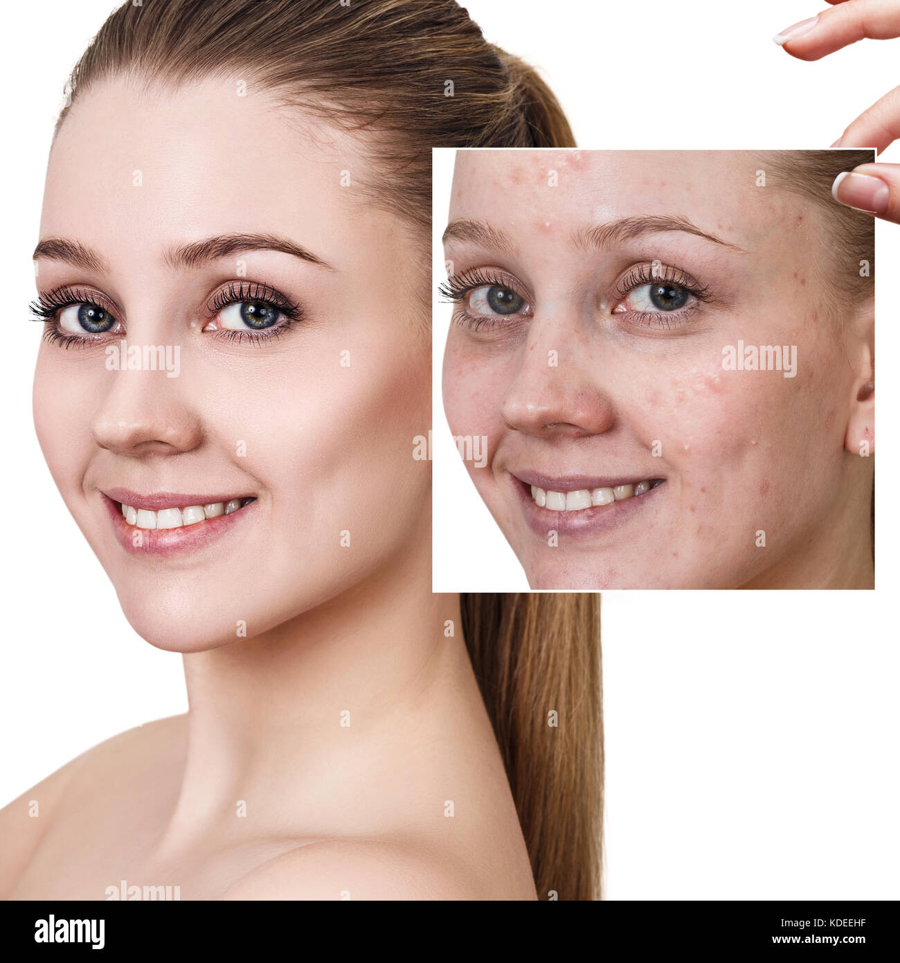 Woman shows photo with bad skin before treatment. Stock Photo
