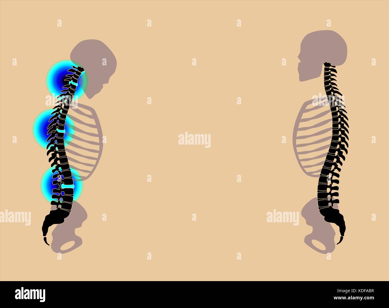 Back problems, neck aches, slipped disc prolapses - curved back with severe pain and healthy back in comparison - illustration on black background. Stock Photo
