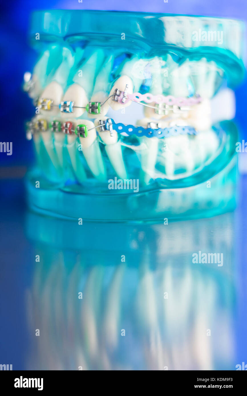 Dental teeth retainers metal aligners brackets to straighten teeth in orthodontic dentistry