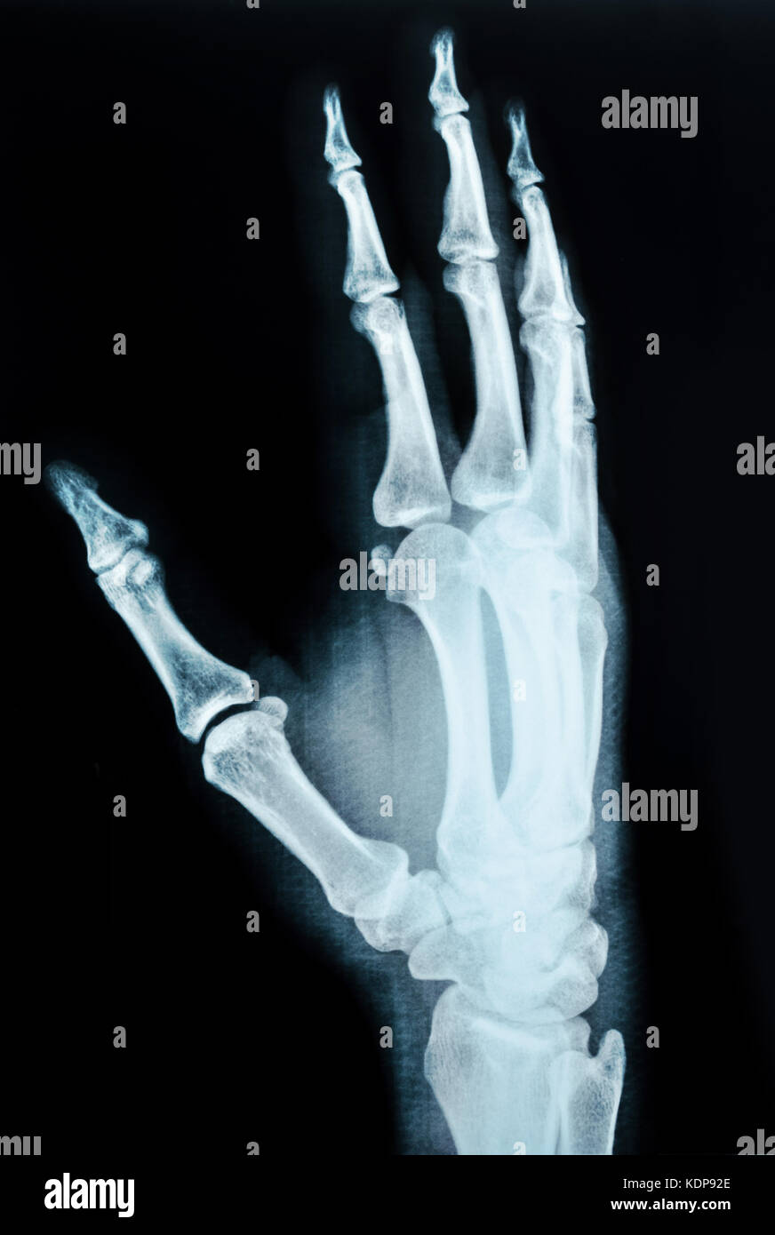black and white photo of x-ray picture of human hands Stock Photo