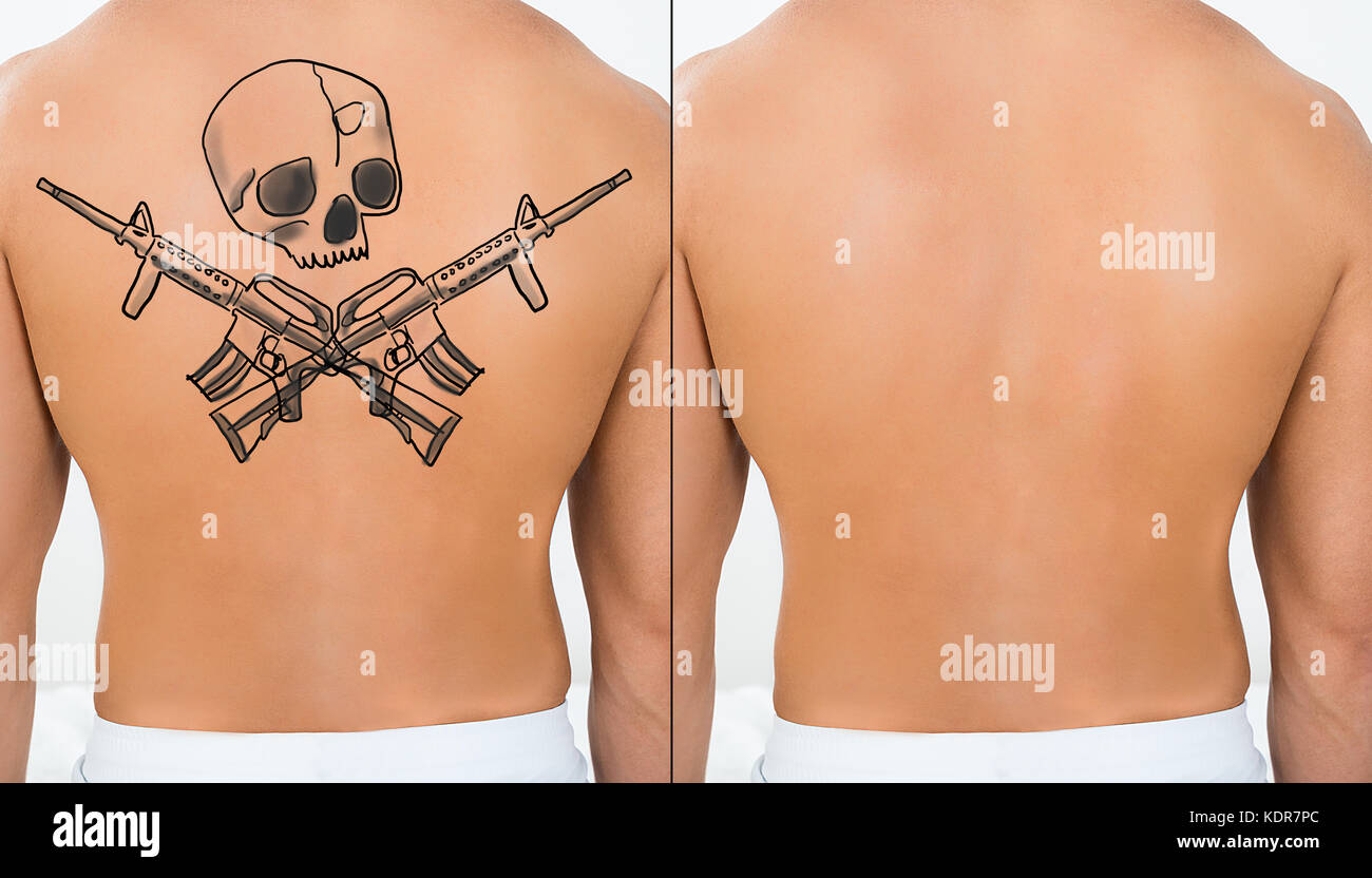 Person Showing Before And After Laser Tattoo Removal Treatment On Back  Stock Photo - Alamy