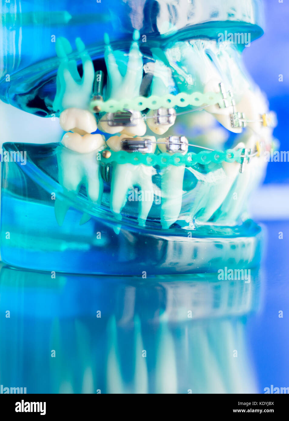 Dental teeth retainers metal aligners brackets to straighten teeth in