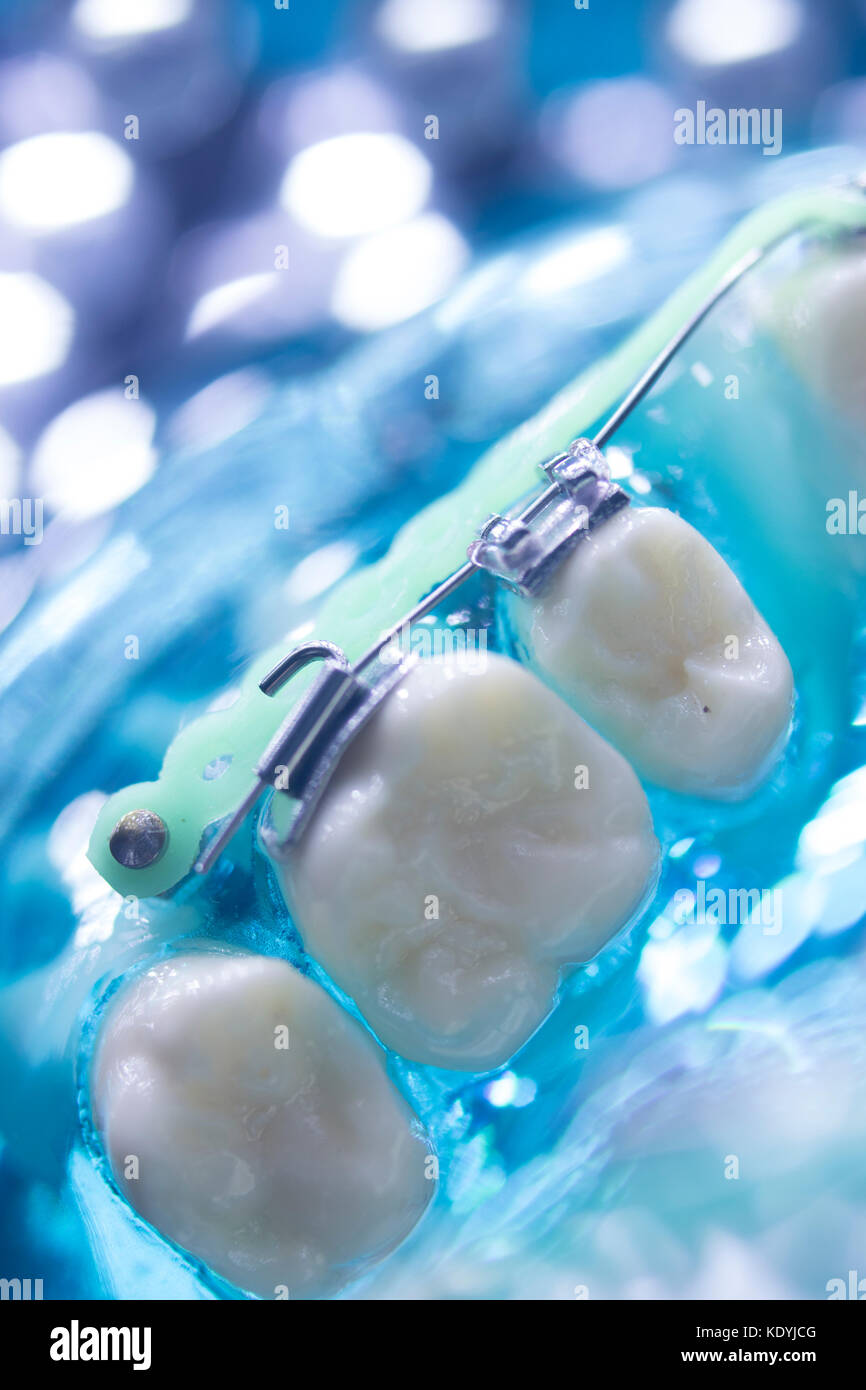 Dental teeth retainers metal aligners brackets to straighten teeth in