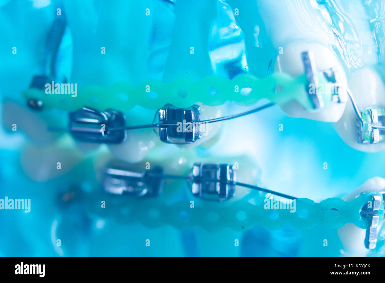 Dental teeth retainers metal aligners brackets to straighten teeth in orthodontic dentistry