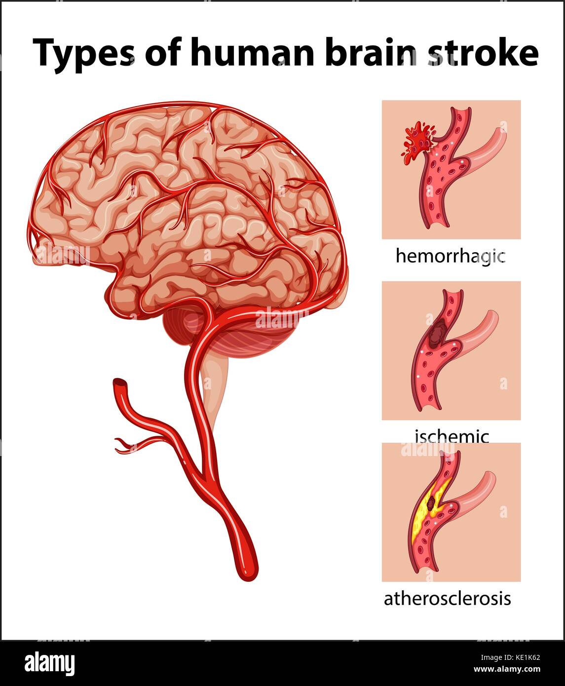 Types of human brain stroke illustration Stock Vector Image & Art Alamy