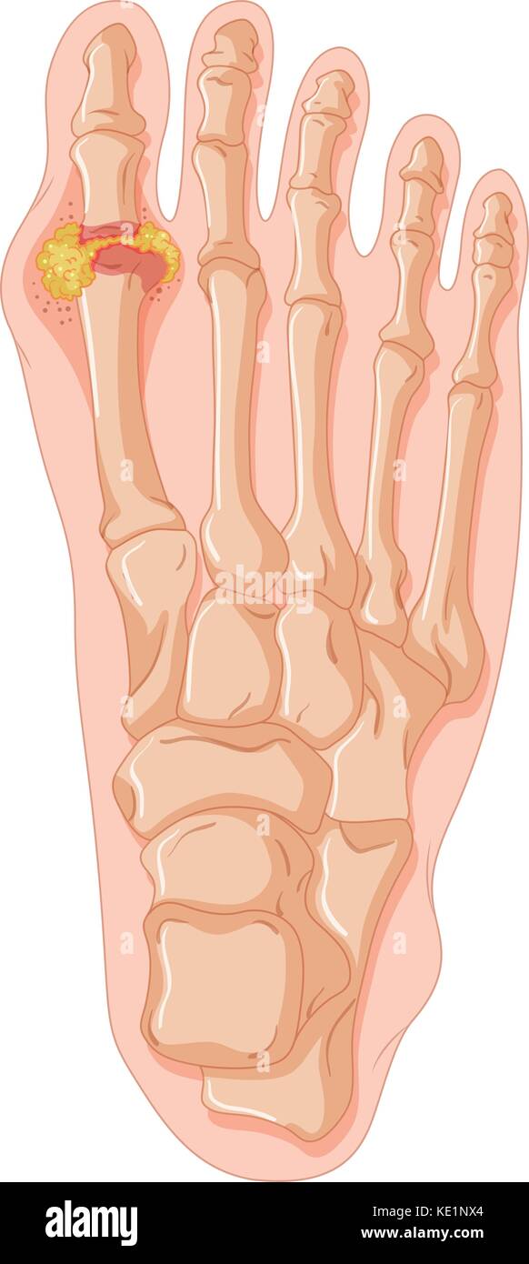 Diagram showing gout toe illustration Stock Vector