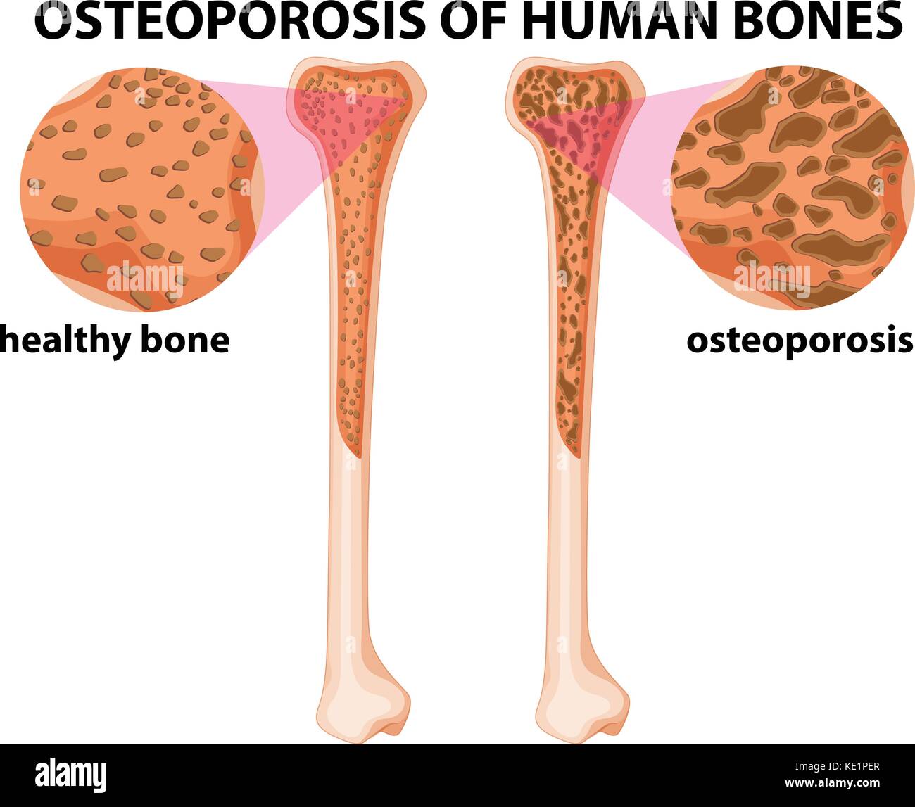 Image Of Osteoporosis Stock Photos Image Of Osteoporosis Stock Images Biology Diagrams