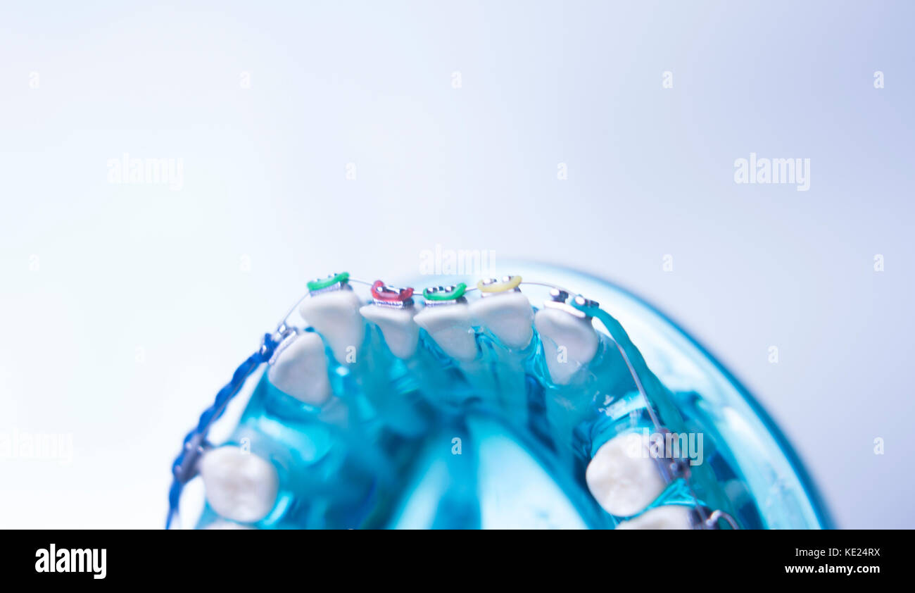Dental teeth retainers metal aligners brackets to straighten teeth in orthodontic dentistry