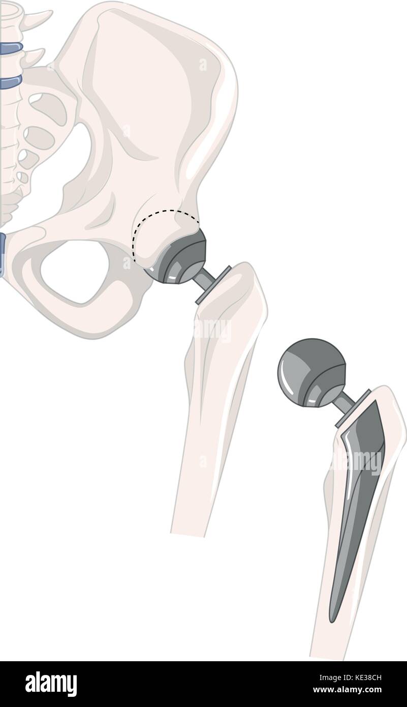 Treatment of human hip bone illustration Stock Vector Image & Art Alamy