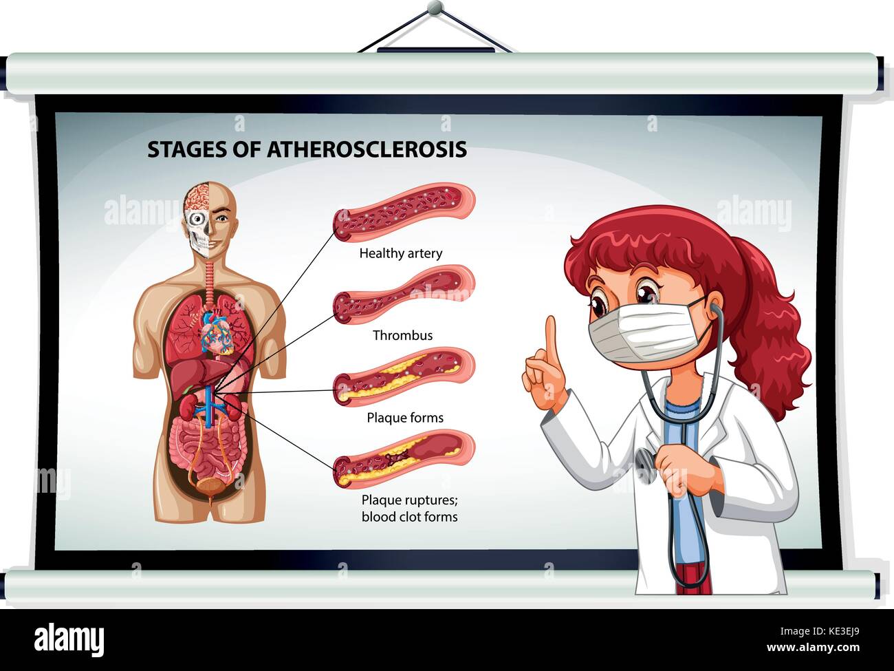 Doctor explaining stages of atherosclerosis illustration Stock Vector ...
