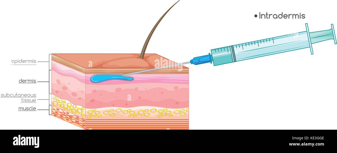 Injection under human skin illustration Stock Vector
