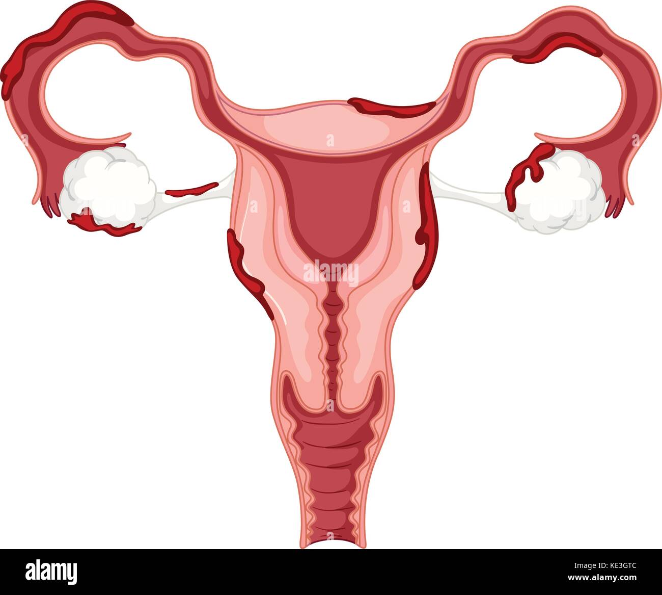 Diagram of woman ovary with endometriosis illustration Stock Vector