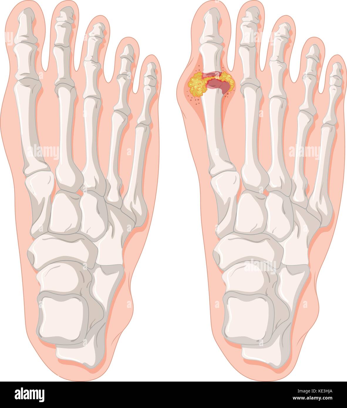 Gout toe in human feet illustration Stock Vector