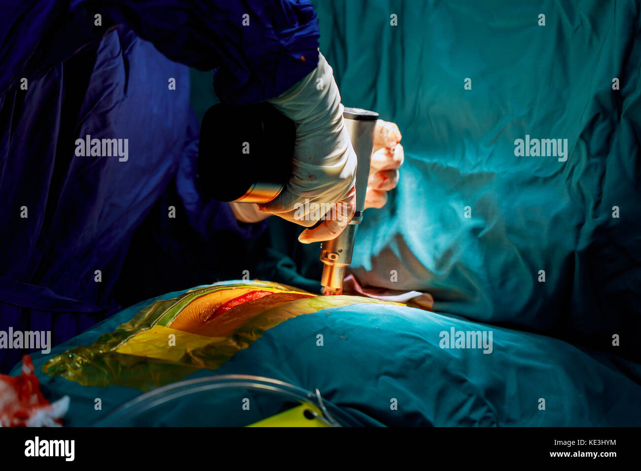 Open chest wound hires stock photography and images Alamy