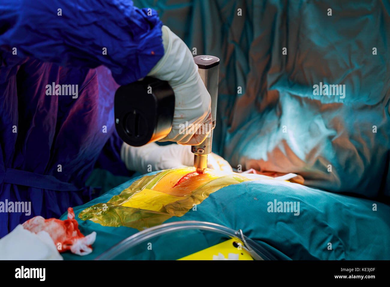 Cutting the chest during an operation on the heart The doctor and staff are treating with open heart cardiac bypass surgery in full operation room Stock Photo