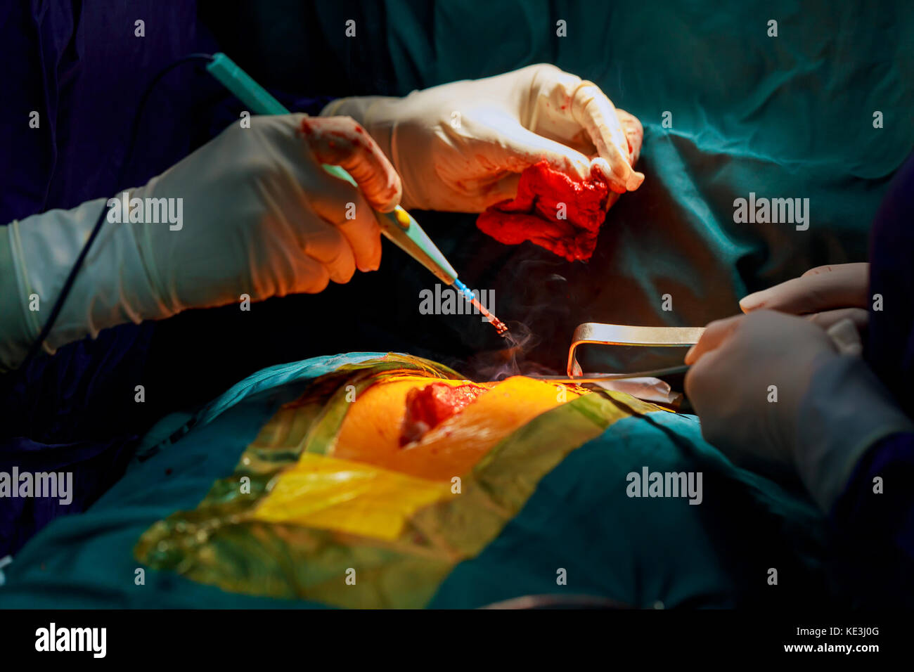 Disposable electrosurgical pencil. Incision on the chest. Cutting the Stock Photo - Alamy Disposable electrosurgical pencil. Incision on the chest. Cutting the Stock Photo - Alamy