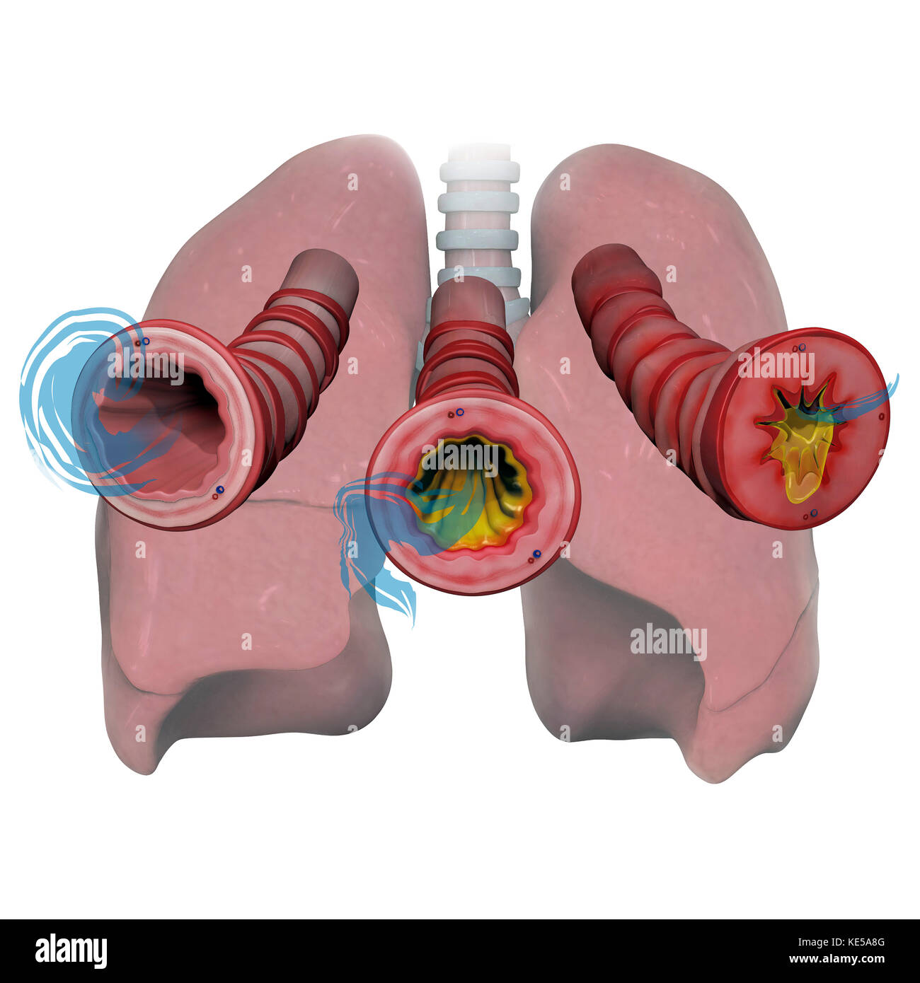 Lungs and bronchioles depicting asthma stages of inflammation and mucus. Stock Photo