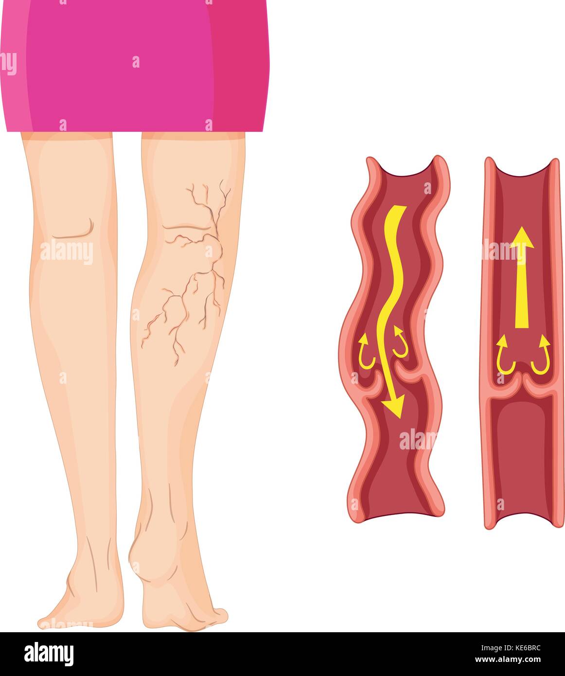Varicose veins in human leg illustration Stock Vector Image & Art - Alamy