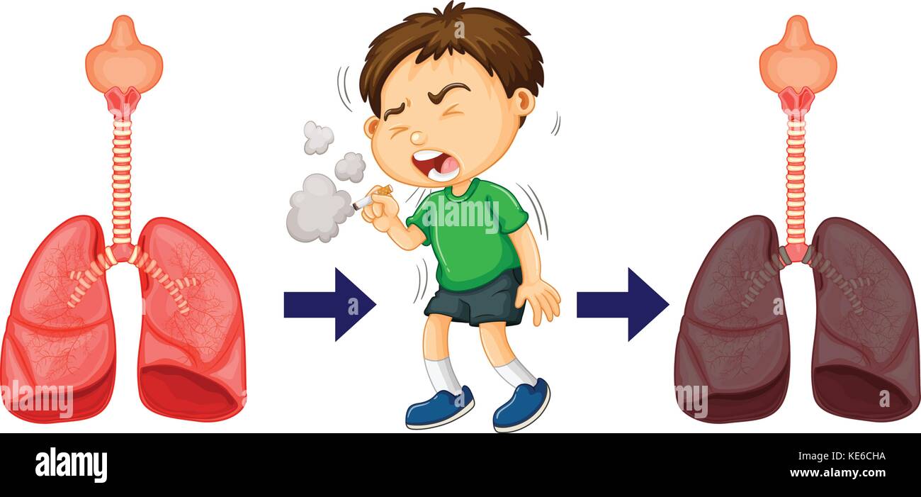 Boy smoking and lung cancer illustration Stock Vector Image & Art - Alamy