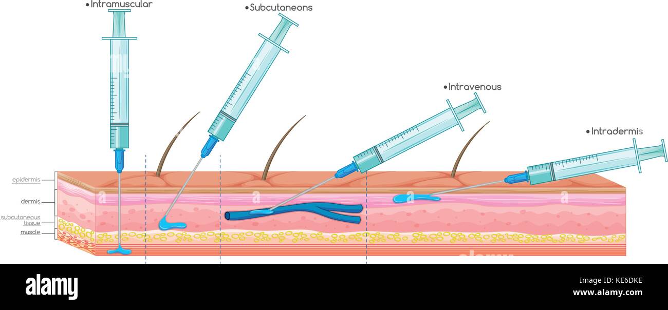 Diagram showing injection with syringe illustration Stock Vector Image