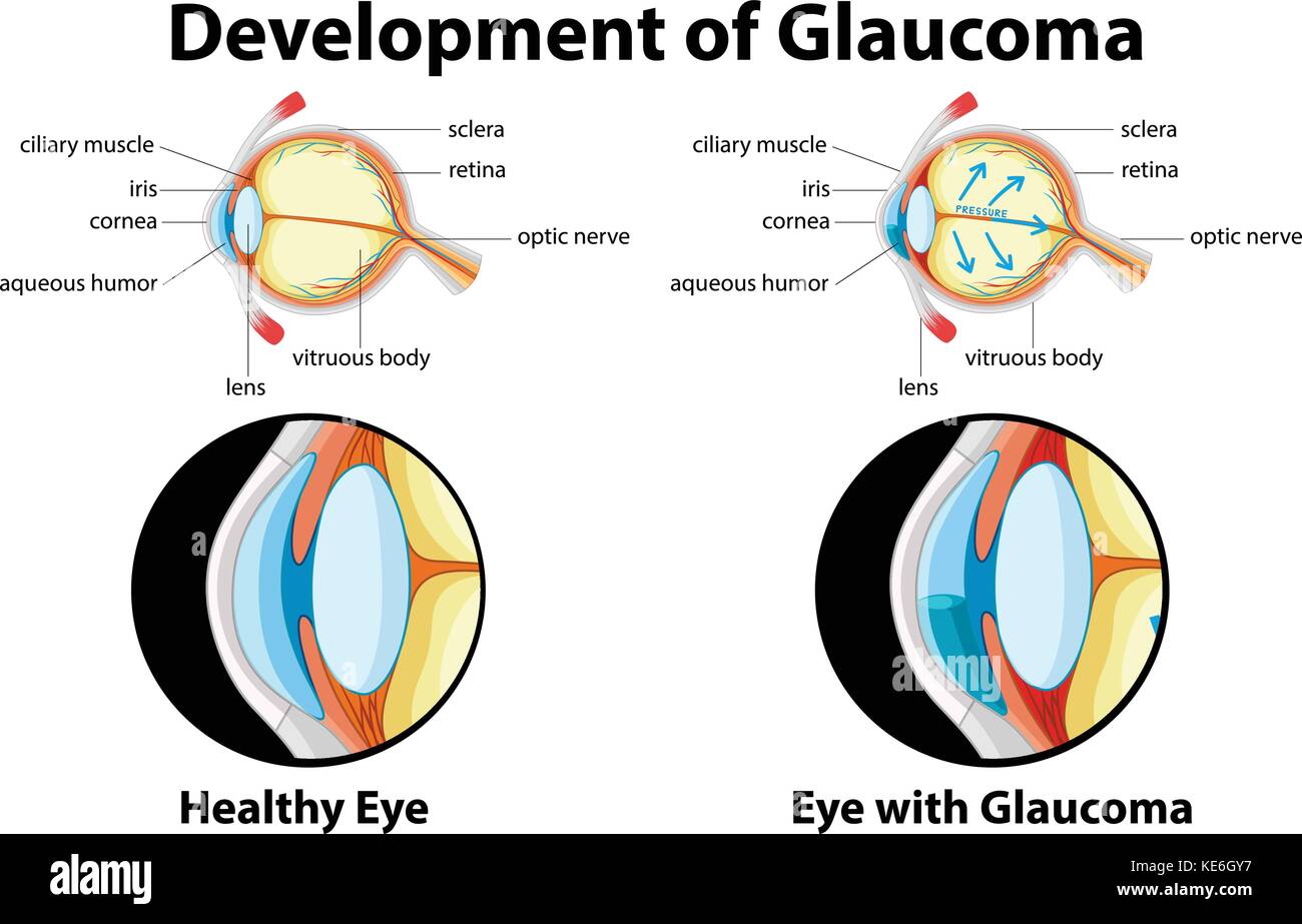 Diagram showing development of glaucoma illustration Stock Vector