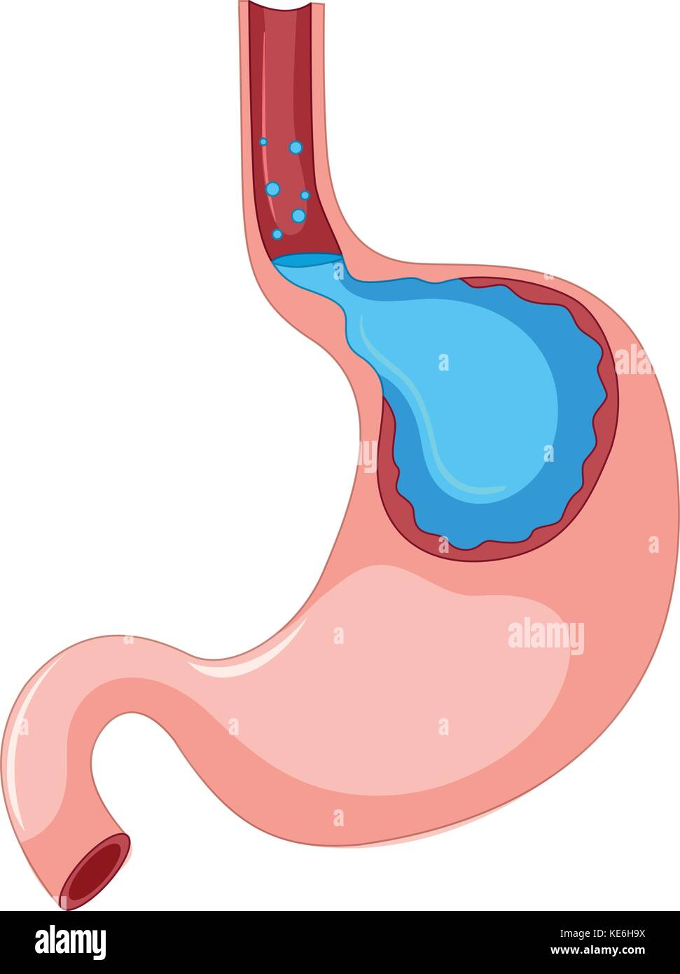 Gastroesophageal Reflux Disease Stage Illustration Stock Vector Image gastroesophageal-reflux-disease-stage-illustration-stock-vector-image