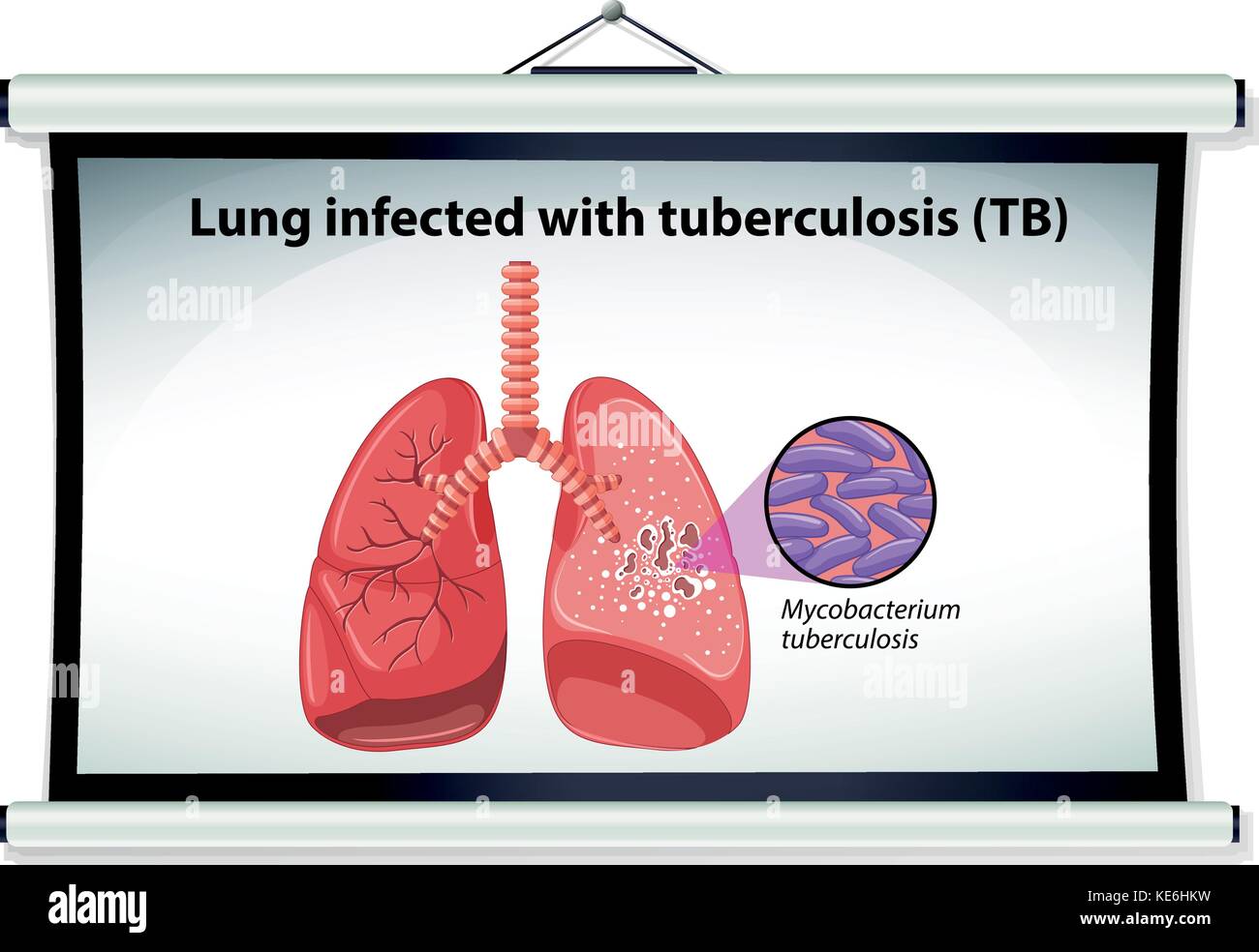 Diagram showing lung cancer illustration Stock Vector Image & Art - Alamy