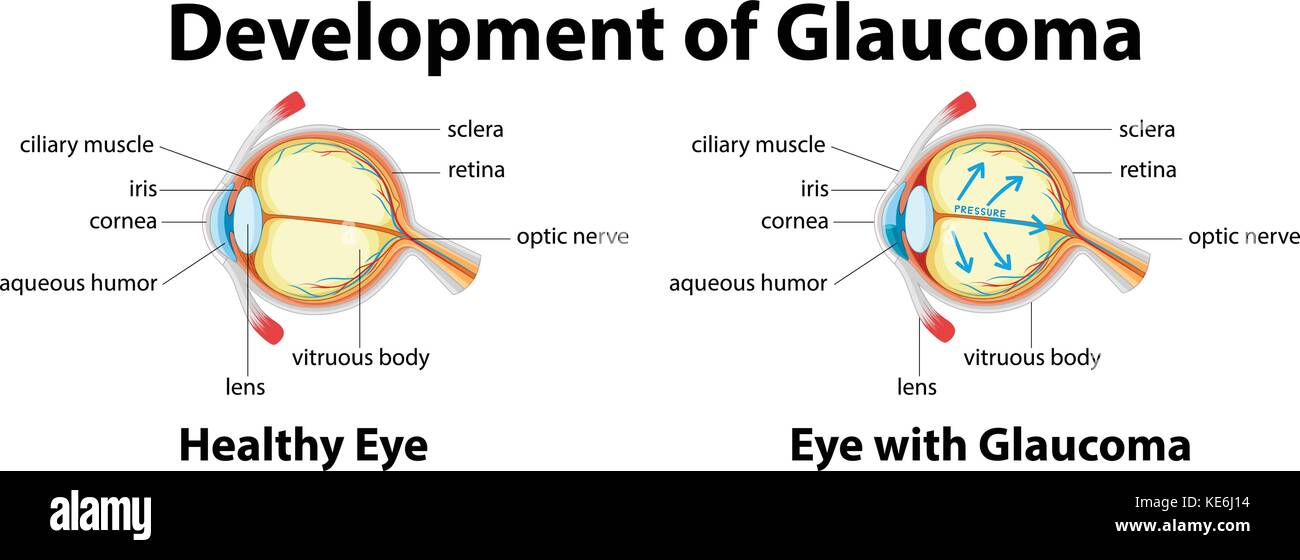 Development of Glaucoma in human eyes illustration Stock Vector